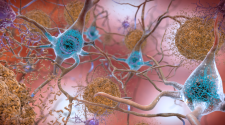 Alzheimer's Biomarkers Move Ahead In Research : Shots