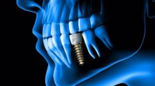 New technology to improve dental implant bridges receives US patent