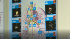 New lung technology at St. Francis helps doctors determine lung cancer | KTVE