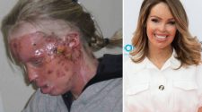 World Mental Health Day 2019 – Katie Piper shares harrowing photo of acid attack injuries for first time – The Sun