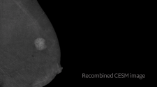 GE Healthcare Unveils Novel Contrast-enhanced Mammography Solution for Biopsy