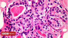 Immune discovery 'may treat all cancer'