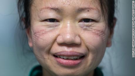 The marks of a mask are seen on the face of nurse Cao Shan after working in the isolation ward in Jinyintan Hospital, designated for Covid-19 patients, in Wuhan, China.