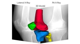 RSIP Vision Announces Breakthrough AI technology for 3D Reconstruction of Knees from X-ray Images