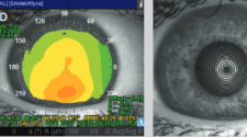 Virtual corneal topography screening