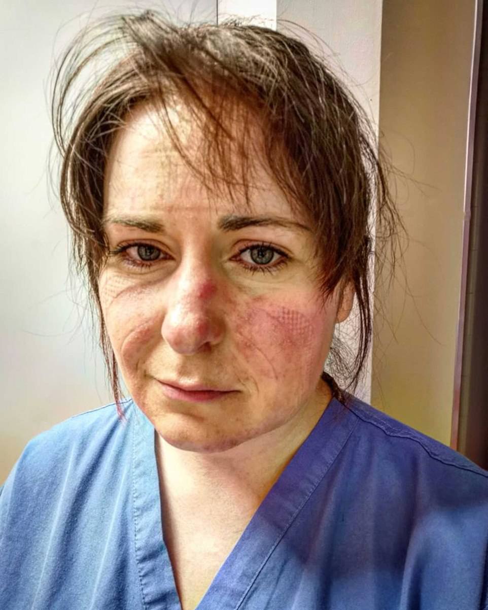 Kate added of an image of a nurse marked by a PPE mask: 'It's a really harrowing image, they're the things that not everyone at home will witness so it's important to see what those on the front line are experiencing'. ICU nurse Aimee Goold posted a heartbreaking image of her tired and scared face, pleading with people to stay home