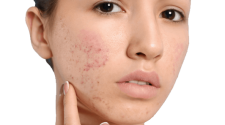 Are you breaking out? These surprisingly simple reasons could be why you have adult acne 4