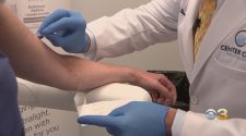 New Technology Changing How Doctors Diagnose Skin Cancer Without Painful Biopsies – CBS Philly