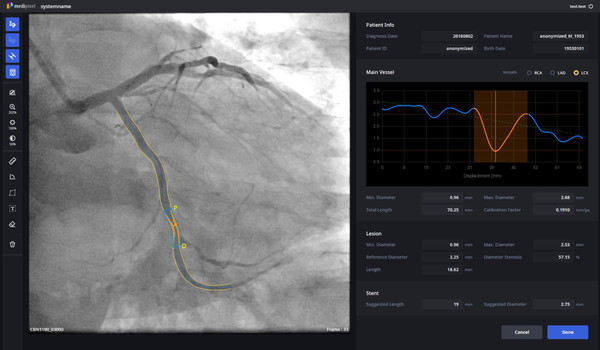 A single screen of Medipixel XA shows cardiovascular contour and lesion site as well as recommended stent types. (Credit: Medipixel).