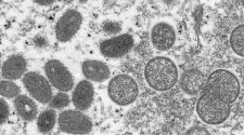 Health officials predict more monkeypox cases, but no widespread outbreak